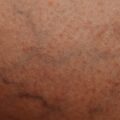 Varicose Veins, Should I Opt to Have a Surgical Procedure