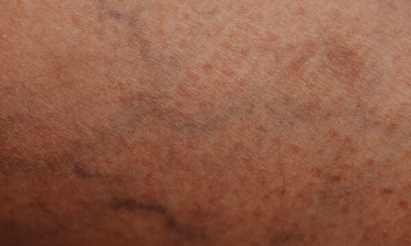 Varicose Veins, Should I Opt to Have a Surgical Procedure