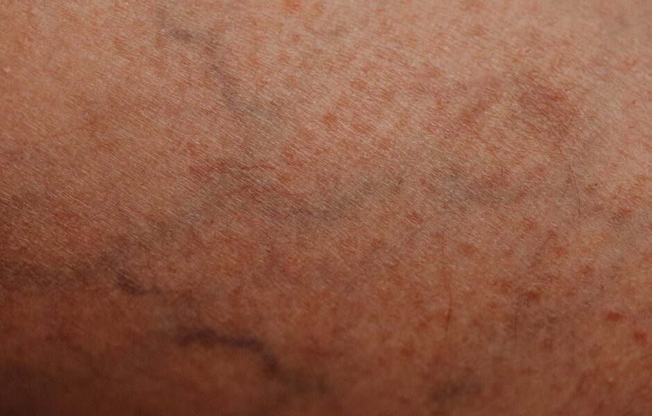 Varicose Veins, Should I Opt to Have a Surgical Procedure