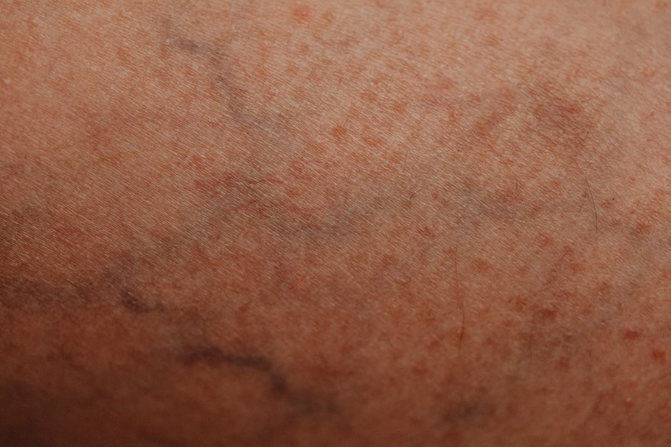 Varicose Veins, Should I Opt to Have a Surgical Procedure